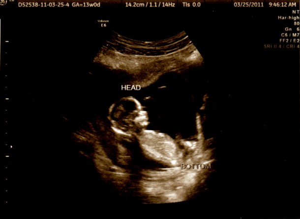 13 Week Ultrasound
